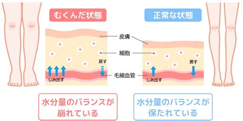 浮腫病|むくみ（浮腫）は病気のサインかも？症状や主な原因。